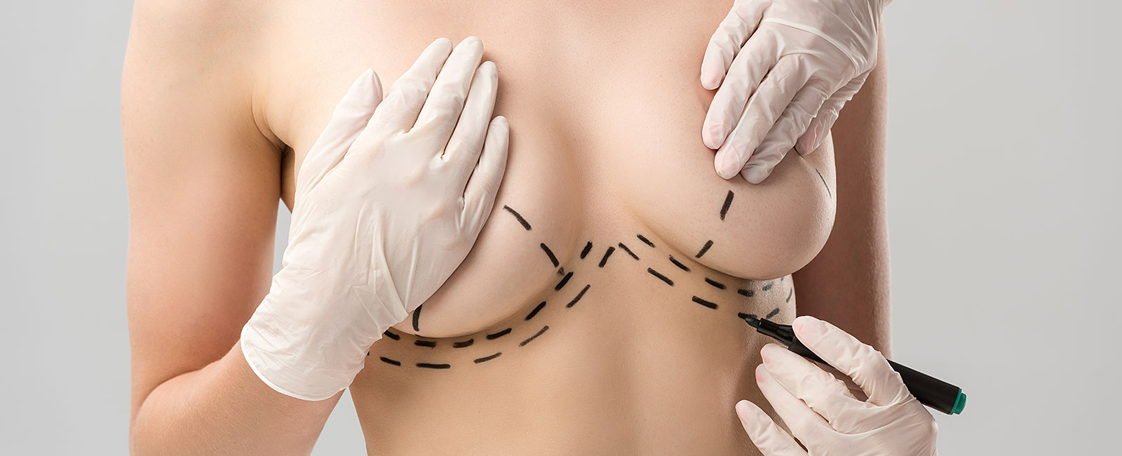 A person at a breast lift consultation has surgical guidelines marked on their skin by a gloved professional.