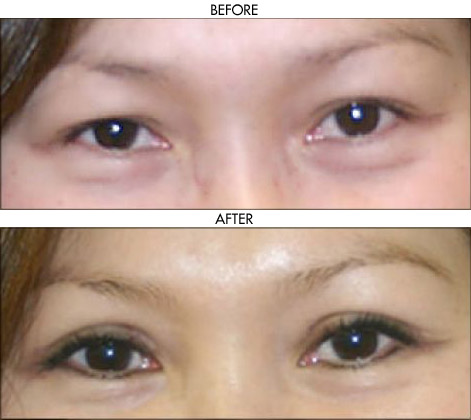 Facelift before and after