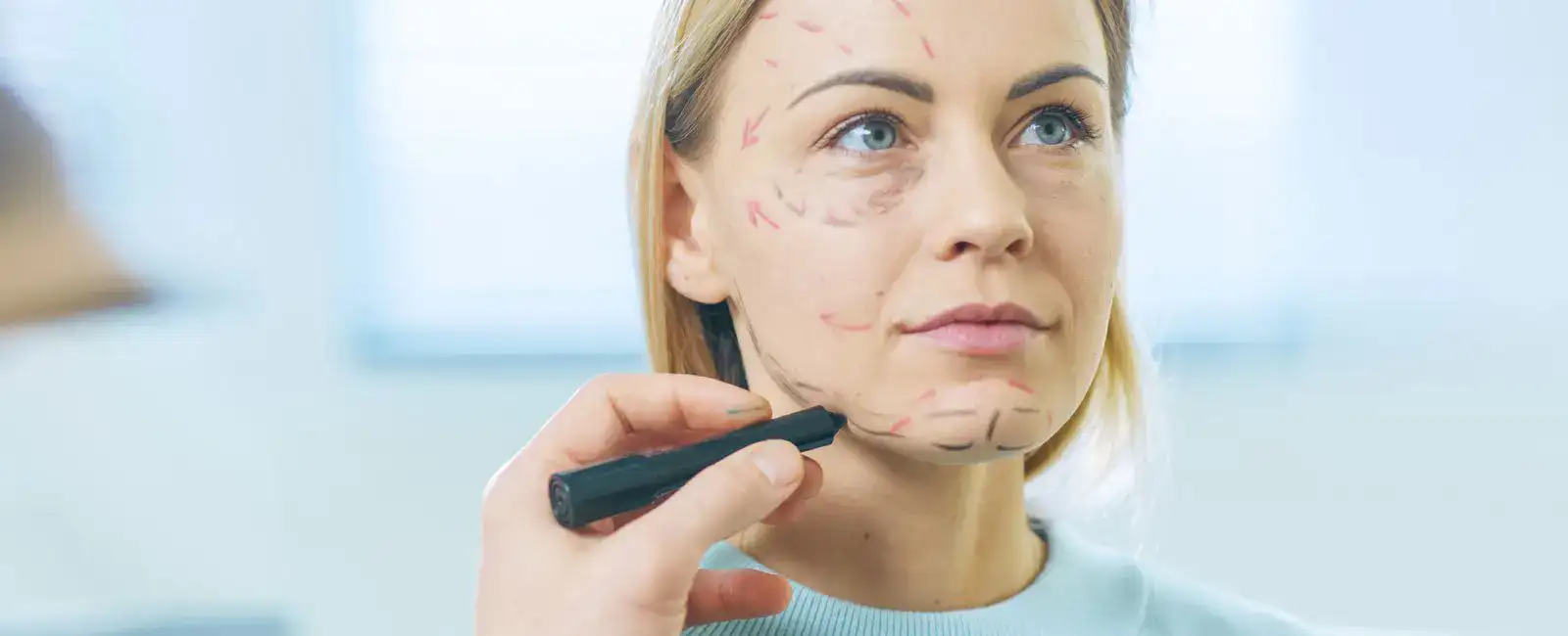 A calm blonde woman sits as surgical lines are drawn on her face