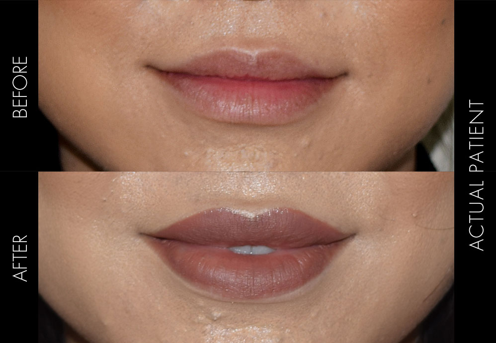 Lip Injection Before & After Before and after images of a patient who has received lip injections to improve the size, shape and volume of the lips. Hyaluronic acid filler was used for the treatment.